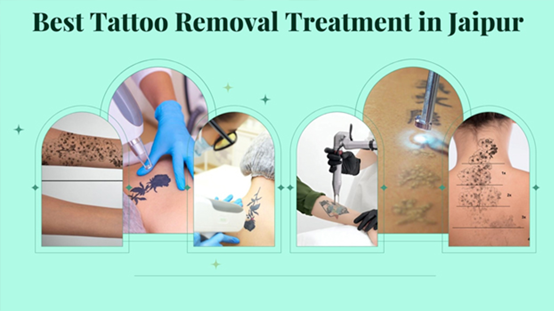 Best Tattoo Removal Treatment in Jaipur