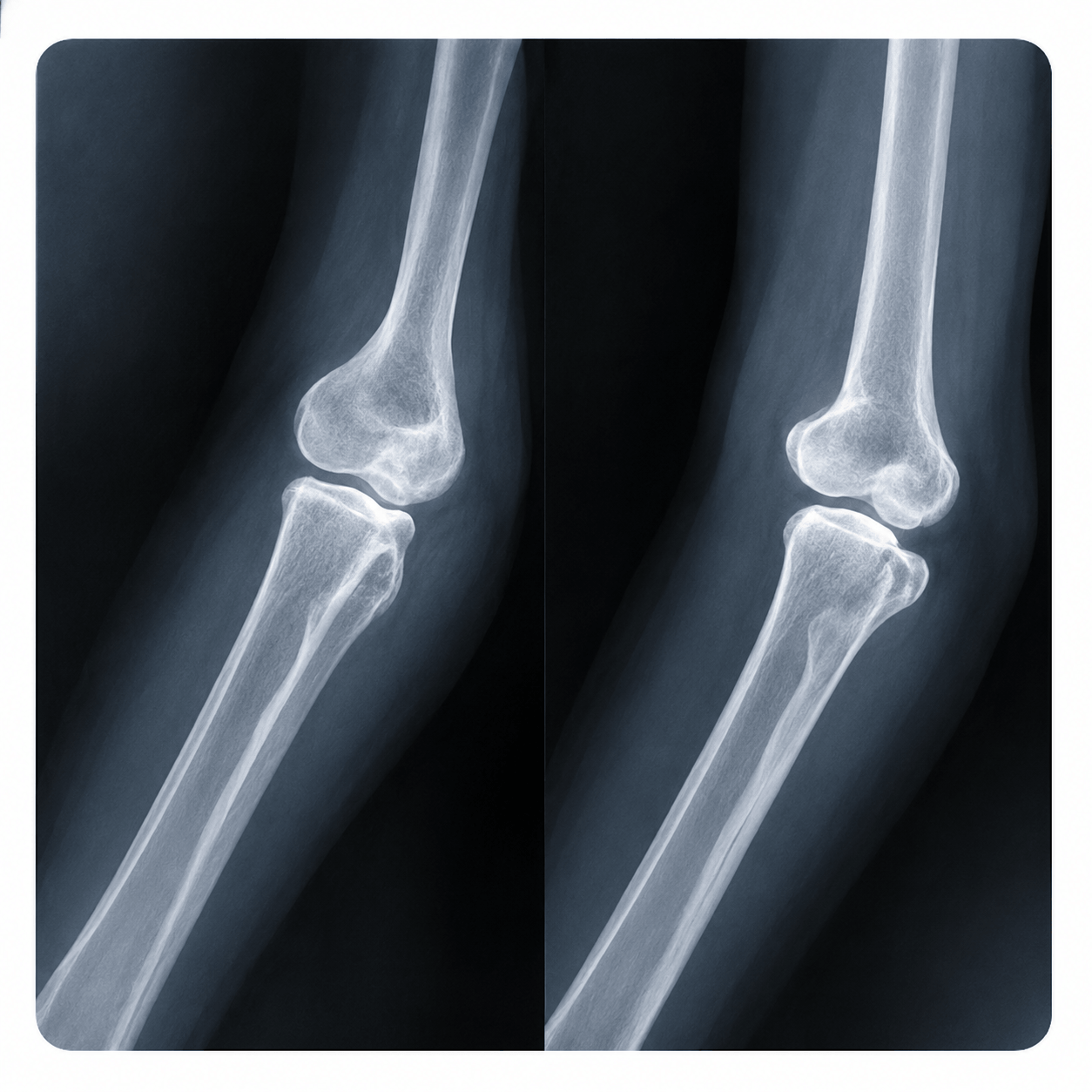 img of fracture-treatment
